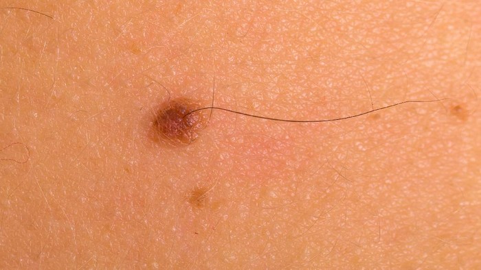 tahi lalat Close up photo of a benign birthmark