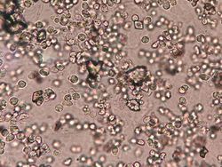 Cantik Tapi Mengerikan, Kristal Asam Urat di Bawah Lensa Mikroskop