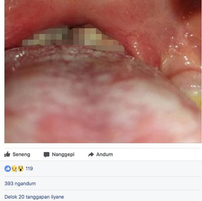 Seram! Seperti Ini Risikonya Jika Melewatkan Vaksin Difteri