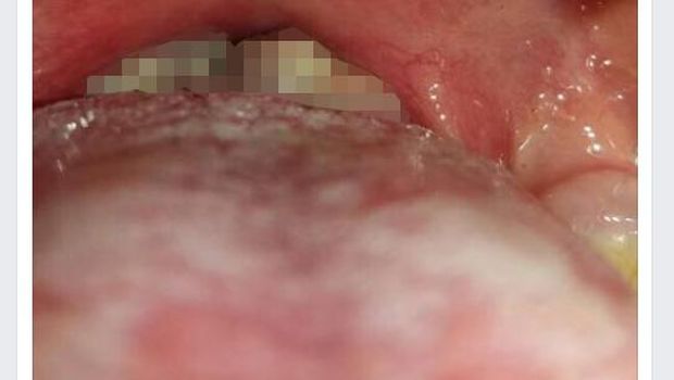 Dampak yang ditimbulkan akibat difteri yang menyerang tenggorokan.