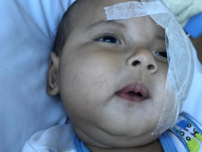 Belum Berusia Satu Tahun Bayi Asri  Welas  Dioperasi Katarak 