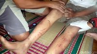 kaki Yusup yang terluka