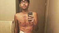 Bekas luka transplantasi dengan bangga ditunjukkan oleh Erik Rodriguez. Bagi Erik luka-luka tersebut menunjukkan seberapa jauh perjuangannya untuk bisa bertahan hidup dengan jantung baru. (Foto: Instagram/erik_r_2.0)
