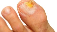 Pernah menjumpai kuku yang berwarna kekuningan? Kuku yang berwarna kuning adalah tanda kuku terkena jamur. Pada kasus yang parah hingga terjadi infeksi, kuku menebal dan bertekstur kasar. (Foto: ilustrasi/thinkstock)