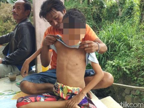 Bocah Kelas 5 SD di Sukabumi Mendadak Lumpuh Usai Imunisasi