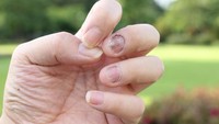 Beberapa penyakit autoimun seperti psoriasis atau arthritis memiliki gejala dengan kuku berwarna kecoklatan yang disertai dengan tekstur kuku yang bergelombang. (Foto: ilustrasi/thinkstock)
