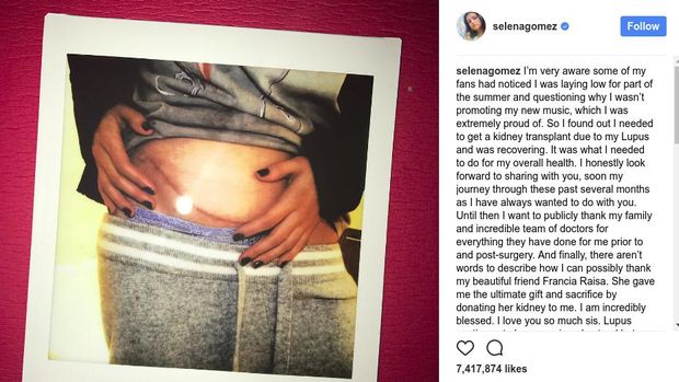 Bekas transplantasi ginjal Selena Gomez