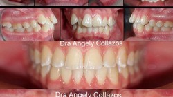 Pada dasarnya gigi memiliki posisinya masing-masing. Namun, tak jarang gigi tumbuh berantakan sehingga perawatan khusus seperti menggunakan behel diperlukan.