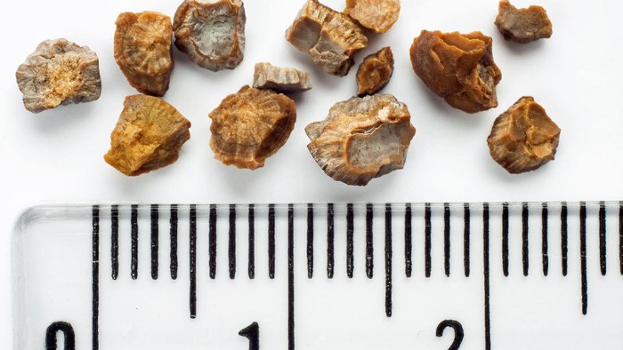 Kidney stones after ESWL intervention. Lithotripsy. Scale in centimeters