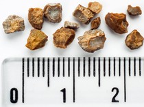 Ciri-ciri Terkena Batu Ginjal, Bisa Terlihat Lewat Urine