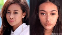 Perbedaan bibir Ratu Felisha dulu dan sekarang. (Foto: Dok. detikHOT)