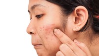 Susu sama sekali tidak ada timbal balik yang baik untuk kulit. Ahli dermatologi justru menganjurkan untuk mengurangi konsumsi produk susu bila Anda memiliki masalah kulit seperti jerawat, eksim atau gangguan kulit lainnya. Foto: Thinkstock
