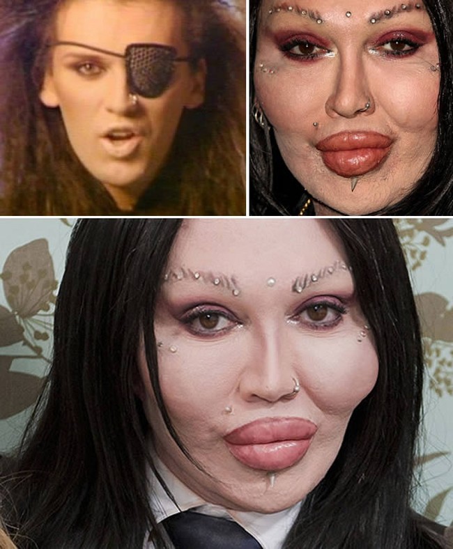 Gagal implan bibir, penyanyi bernama Pete Burns ini berakhir dengan bibir yang super bengkak. Pete sangat kesal dengan dokter kecantikannya yang menghancurkan penampilannya hingga menuntut klinik kecantikan tersebut. Foto: ist.