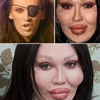 Gagal implan bibir, penyanyi bernama Pete Burns ini berakhir dengan bibir yang super bengkak. Pete sangat kesal dengan dokter kecantikannya yang menghancurkan penampilannya hingga menuntut klinik kecantikan tersebut. Foto: ist.