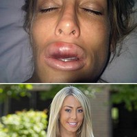 Model bernama Laura Summers ini obsesi dengan bibir tebal bervolume. Ia melakukan filler namun hasilnya tidak seperti harapannya. Bibirnya jadi jontor. Melihat penampilannya tersebut, Laura shock dan mengatakan bahwa penampilannya seperti monster. Bahkan selama dua tahun bibirnya tak kembali ke ukuran normal. Foto: ist.