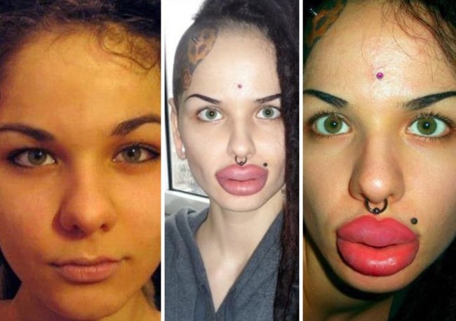 Bukan disengat lebah, bibir bengkak wanita ini karena gagal dalam injeksi pembesaran bibir. Saking bengkaknya, bibir wanita ini seperti mau meledak. Foto: ist.