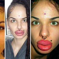 Bukan disengat lebah, bibir bengkak wanita ini karena gagal dalam injeksi pembesaran bibir. Saking bengkaknya, bibir wanita ini seperti mau meledak. Foto: ist.