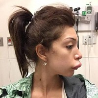 Bintang reality TV Farrah Abraham memang sudah akrab dengan bedah plastik. Ia pun mencoba melakukan filler bibir, sayangnya berakhir gagal hingga dilarikan ke rumah sakit. Bibir Farrah bengkak dan lebih maju seperti bibir bebek. Foto: ist.