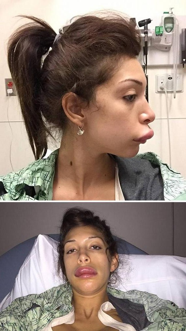 Bintang reality TV Farrah Abraham memang sudah akrab dengan bedah plastik. Ia pun mencoba melakukan filler bibir, sayangnya berakhir gagal hingga dilarikan ke rumah sakit. Bibir Farrah bengkak dan lebih maju seperti bibir bebek. Foto: ist.
