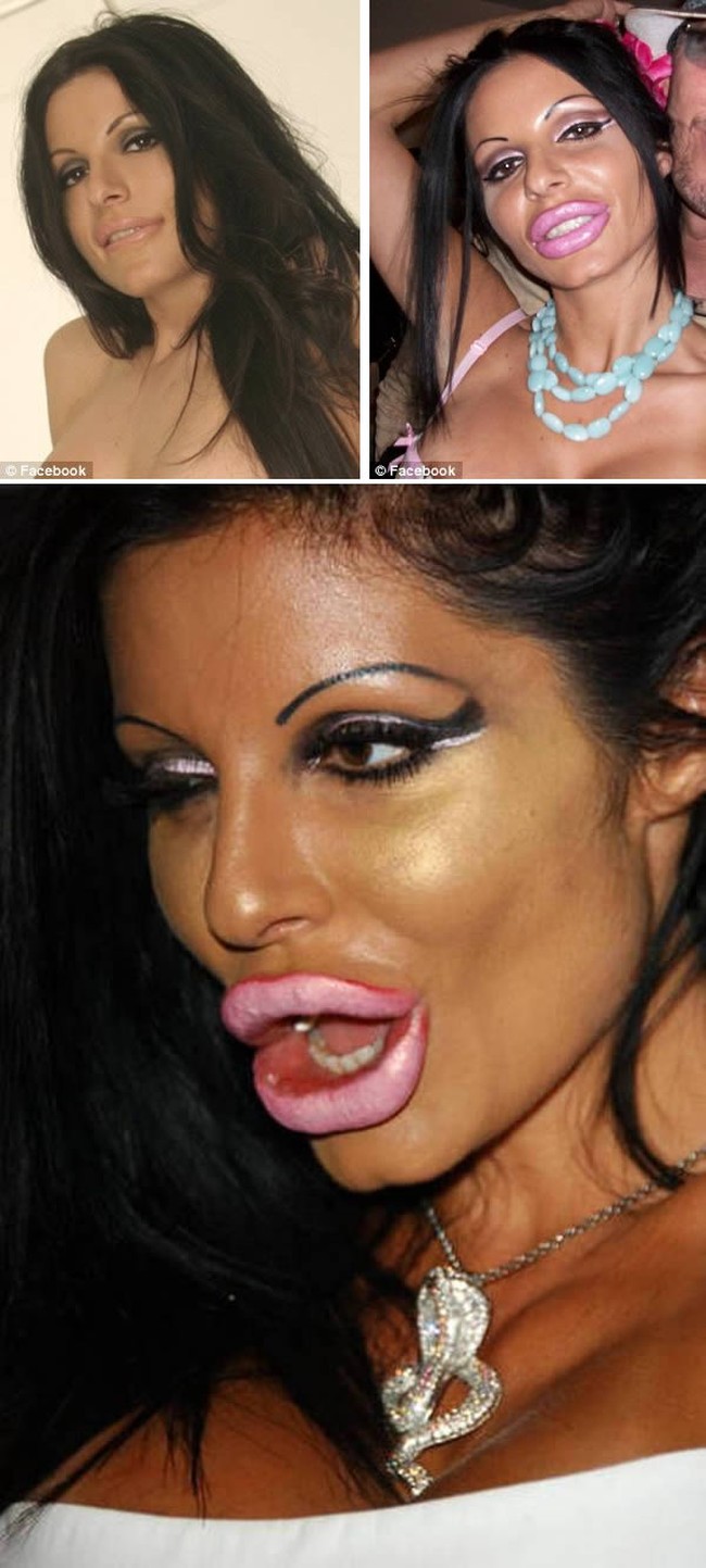 Model bernama Priscilla Caputo mengaku kecanduan operasi plastik karena kekasihnya yang seorang dokter bedah plastik. Hingga suatu hari, bibirnya menjadi super tebal dan jontor karena kebanyakan suntik kolagen di bibirnya. Priscilla pun sempat menjadi bahan olok-olokan di Internet yang membuatnya ingin bunuh diri. Foto: ist.