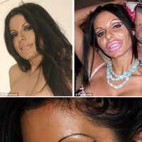 Model bernama Priscilla Caputo mengaku kecanduan operasi plastik karena kekasihnya yang seorang dokter bedah plastik. Hingga suatu hari, bibirnya menjadi super tebal dan jontor karena kebanyakan suntik kolagen di bibirnya. Priscilla pun sempat menjadi bahan olok-olokan di Internet yang membuatnya ingin bunuh diri. Foto: ist.
