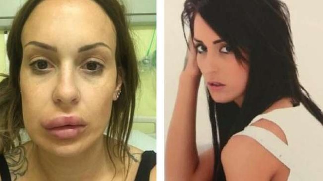 Bentuk bibir wanita bernama  Siobhan Phelan ini jadi tak simetris karena gagal filler. Bibirnya jadi bengkak dan bentuknya jadi tak sesuai. Foto: ist.