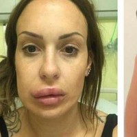 Bentuk bibir wanita bernama  Siobhan Phelan ini jadi tak simetris karena gagal filler. Bibirnya jadi bengkak dan bentuknya jadi tak sesuai. Foto: ist.