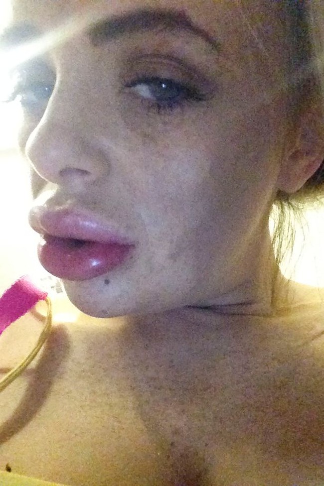 Wanita bernama Leona Omalley juga menjadi wanita yang gagal filler. Penampilan bibirnya yang jontor diibarat Leona seperti dua sosis yang menumpuk di bibirnya. Foto: ist.