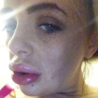 Wanita bernama Leona Omalley juga menjadi wanita yang gagal filler. Penampilan bibirnya yang jontor diibarat Leona seperti dua sosis yang menumpuk di bibirnya. Foto: ist.