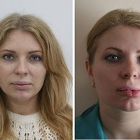 Wanita bernama Hannah Costayer tak menyangka bahwa filler pertamanya yang dilakukannya pada usia 18 tahun mengubah penampilannya selama hidupnya. Prosedur tersebut gagal yang membuat bibirnya jadi miring. Foto: ist.