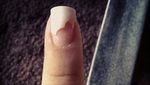 Bikin Ngilu! Potret Kuku yang Rusak karena Pakai Kuku Palsu Sembarangan