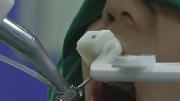 Robot dokter gigi sukses lakukan implan gigi di Cina