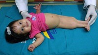 Banyak bayi yang terlahir dengan kondisi ini tidak bertahan setelah sehari atau dua hari dilahirkan karena banyaknya komplikasi yang terjadi. Yang sering ditemukan seperti ketidaknormalan pada sistem pencernaan, tulang pelvis, ginjal yang belum matang, sampai malformasi jantung. Foto: Instagram