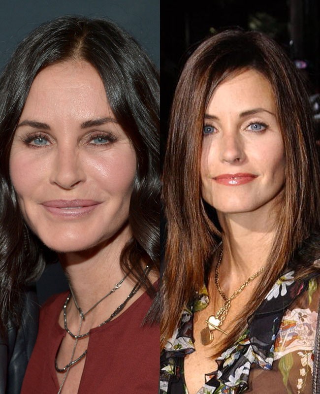 Courteney Cox mengakui pernah memakai botox agar tampak lebih muda dari usianya. Aktris 51 tahun itu diduga juga melakukan facelift sehingga penampilannya kini tampak semakin segar untuk mengimbangi dengan kekasihnya Johnny McDaid yang berusia 38 tahun. Foto: Dok. Getty Images
