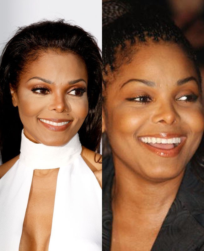 Janet Jackson diduga melakukan operasi hidung beberapa kali. Bentuk hidung Janet semasa kecil yang lebar, kini terlihat berubah menjadi lebih mancung. Adik Michael Jackson itu juga dikabarkan melakukan facelift (operasi membuat wajah menjadi lebih muda dengan menghilangkan keriput). Foto: Dok. Getty Images