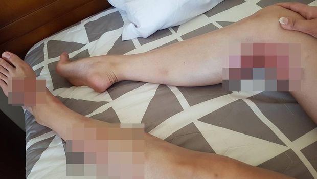 Kaki Stephanie Kim yang penuh lebam.