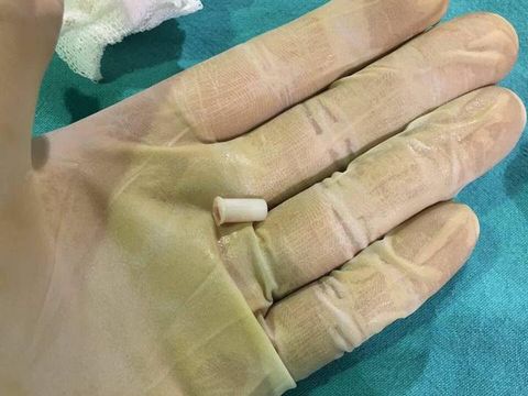 Bagian trompet kecil yang dikeluarkan dari tenggorokan sang anak.