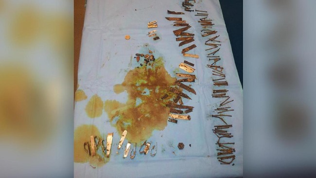 Kasus-kasus Medis Paling Mencengangkan di 2017