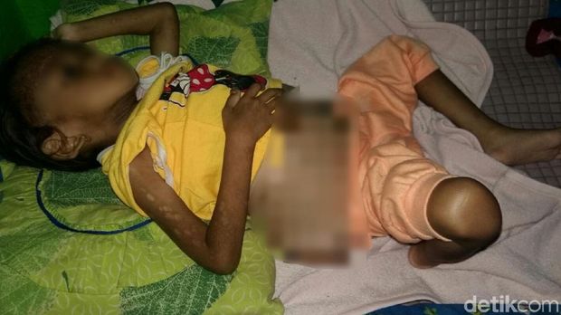 Benjolan itu tumbuh di punggung bagian bawah sebelah kanan