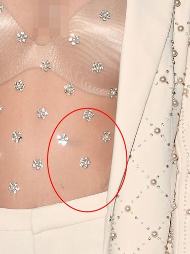 Sahabat Selena Gomez yang Beri Ginjalnya Pamer Bekas Operasi di Red Carpet