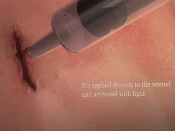 Dadah Plester, di Masa Depan Luka Mungkin Bisa Ditutup Pakai Lem