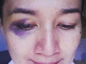 Siti Nurhaliza Hamil Anak Pertama, Begini Kronologi Wajah Nini Carlina Lebam