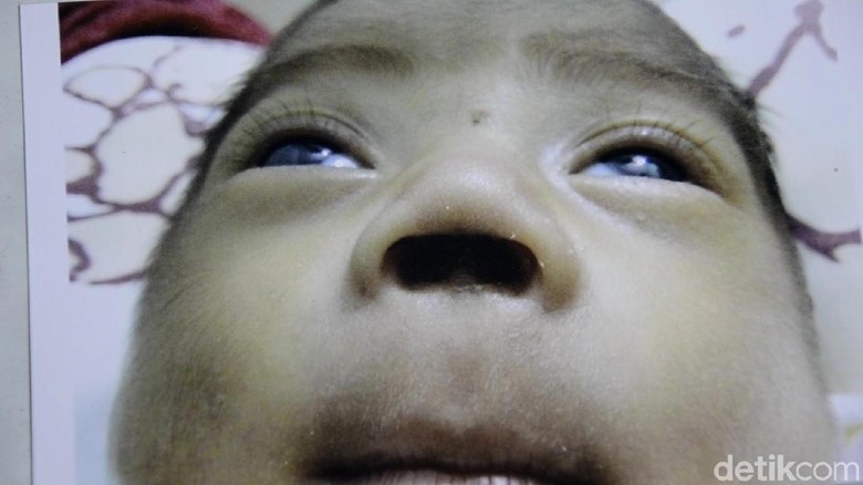 Bupati Pekalongan Janji Awasi Kasus Bayi Kehilangan Sekat Hidung Bupati Pekalongan Janji Awasi Kasus Bayi Kehilangan Sekat Hidung
