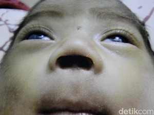 Bupati Pekalongan Janji Awasi Kasus Bayi Kehilangan Sekat Hidung