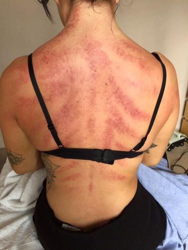 Bule Ini Viral karena Terapi Tradisional, yang Ternyata adalah Kerokan