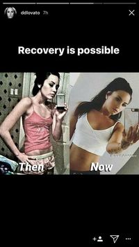Foto Before After Demi Lovato Ini Ungkap Transformasinya Setelah Bulimia
