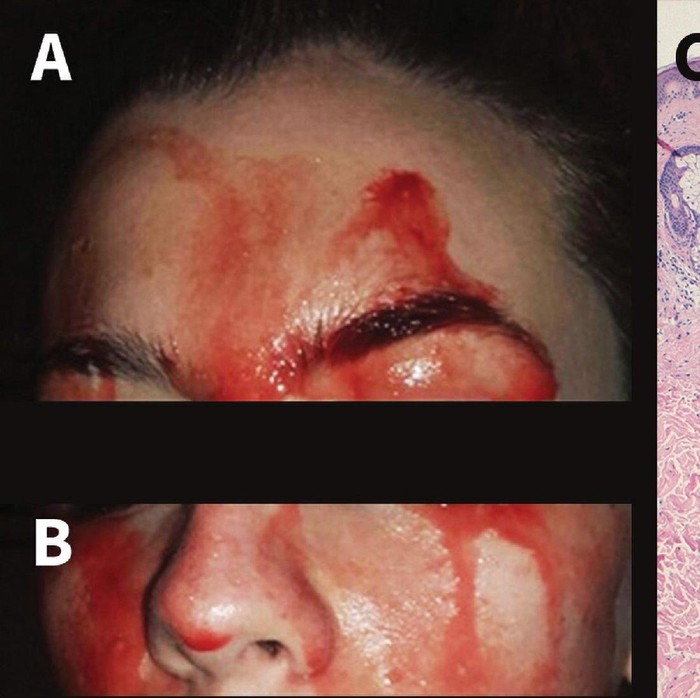 Kondisi Langka Membuat Wanita Ini Mengeluarkan Keringat Darah