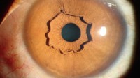 Dokter di China menemukan fitur langka pada mata seorang wanita. Ada jaringan melingkar di matanya yang setelah diteliti ternyata merupakan variasi dari bagian normal bernama iris collarette. Penglihatan sang wanita diketahui tidak terganggu karena hal ini. (Foto: The New England Journal of Medicine)