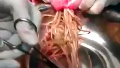 Potret Cacing Parasit yang Sering Dikira Mi dan Menyumbat Usus