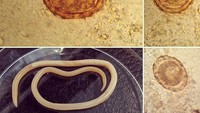 Seseorang bisa terkontaminasi oleh cacing gelang bila tidak sengaja menelan telur dari makanan atau air yang tidak dimasak dengan matang. (Foto: Instagram/fungusdoctor)  